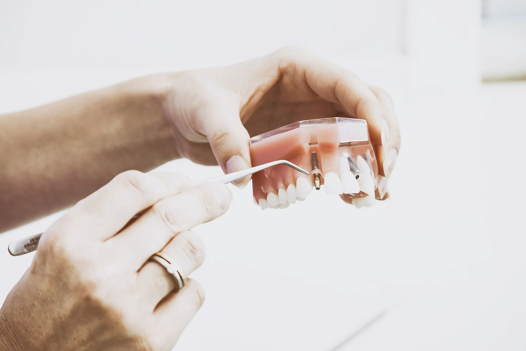 Dentist using a model to explain a threaded dental implant and restoration
